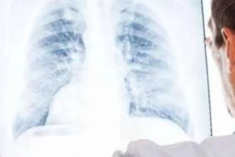 10 Besar Rawat Inap Terbanyak, Ini 8 Cara Mencegah Penyakit Pneumonia