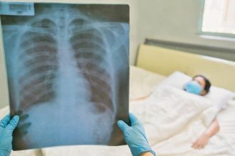 Paru-paru basah, yang dikenal secara medis sebagai pneumonia, adalah peradangan pada salah satu atau kedua paru-paru yang disebabkan oleh infeksi. Infeksi ini dapat disebabkan oleh bakteri, virus, atau jamur, dan menyebabkan penumpukan cairan di kantong udara (alveoli) di paru-paru.