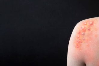 Setelah sembuh dari cacar, umumnya seseorang akan memiliki kekebalan seumur hidup terhadap penyakit ini. Virus varicella-zoster yang menyebabkan cacar juga dapat menyebabkan herpes zoster (cacar api) pada orang dewasa.