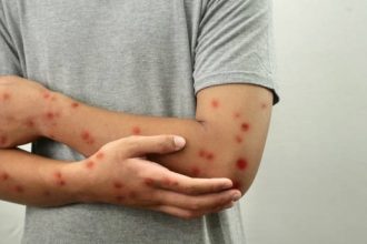 Salah satu faktor risiko utama penularan Mpox adalah kontak langsung dengan lesi kulit yang terinfeksi, cairan tubuh, atau benda yang terkontaminasi oleh cairan tubuh dari individu yang terinfeksi.